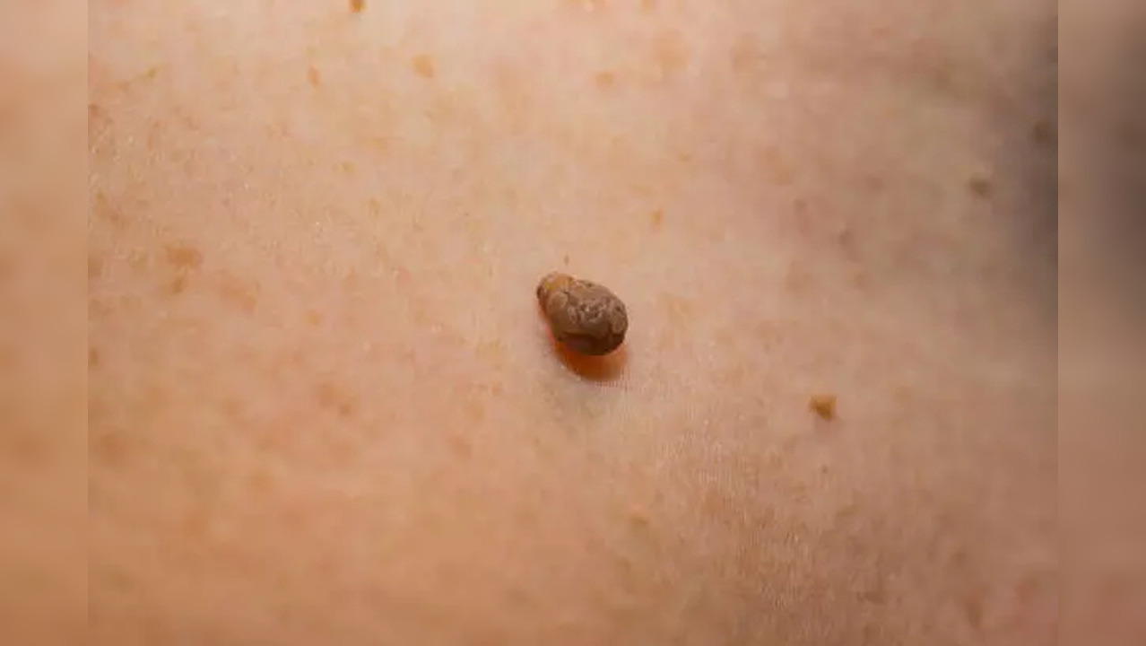 Why do women have more skin tags and warts? Know natural ways to get ...