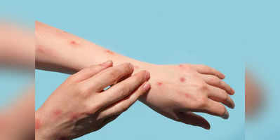 Measles Signs symptoms and when to contact the doctor