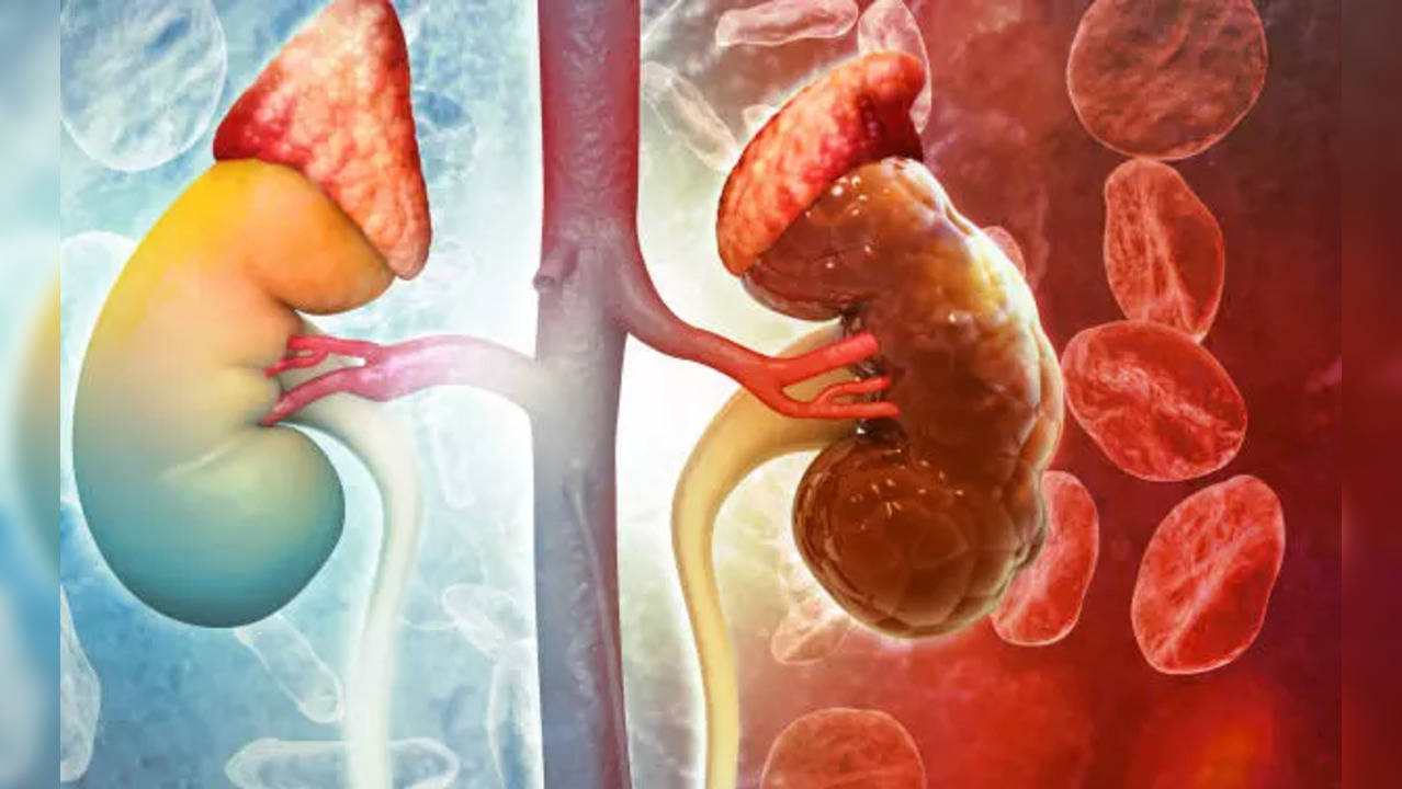 World Kidney Day 2023: Who needs kidney transplant? Doctor weighs in on benefits and risks | Health News, Times Now