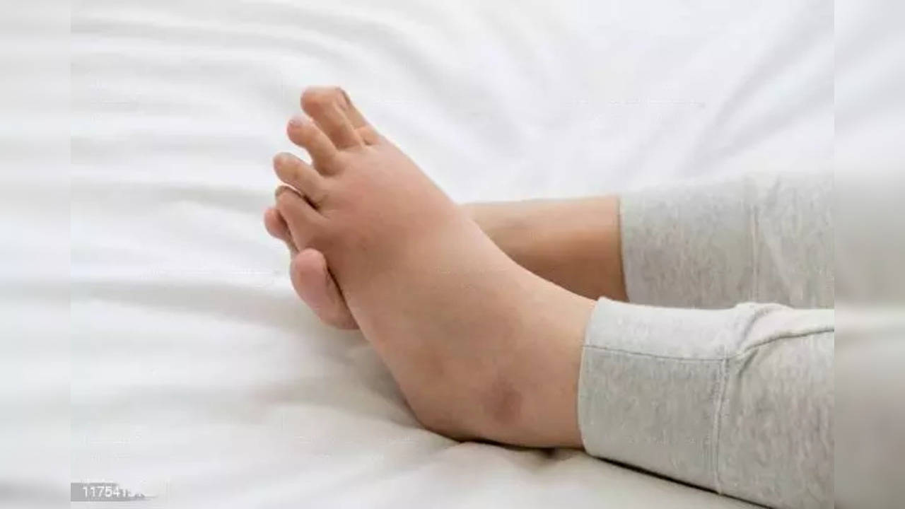 swelling-in-feet-could-point-to-kidney-disorder-experts-health-news