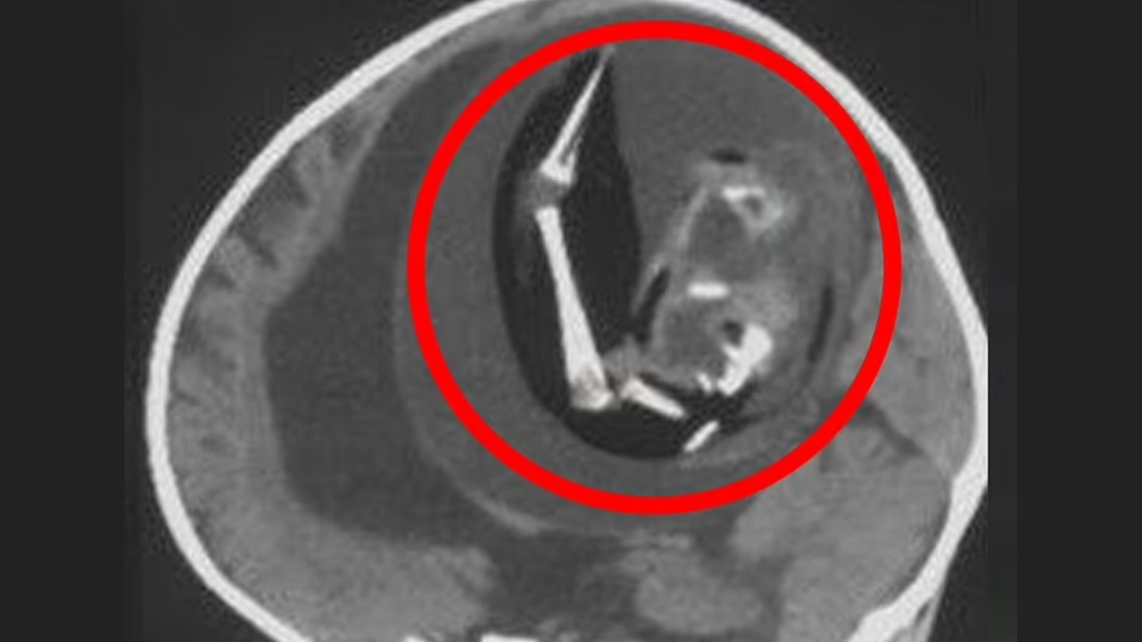 fetus-in-fetu-unborn-twin-removed-from-brain-from-1-year-old-girl-in