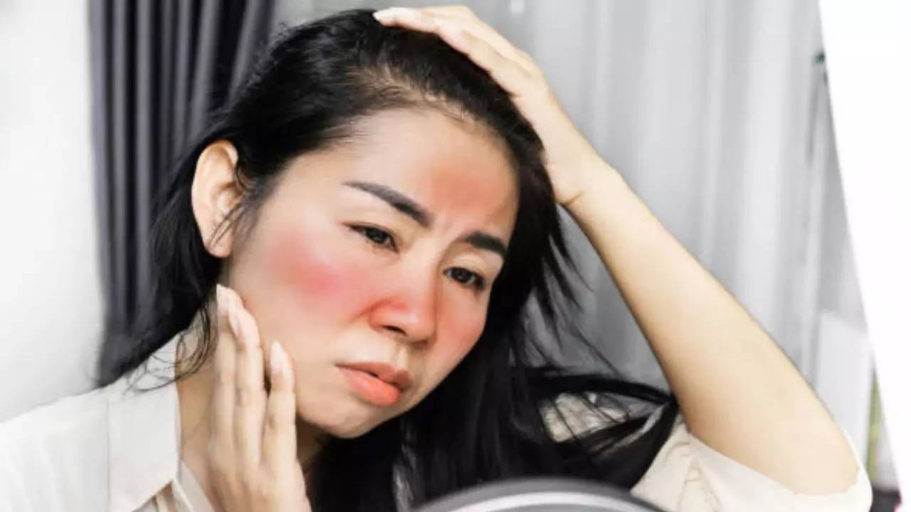 Skin redness (Representative image)