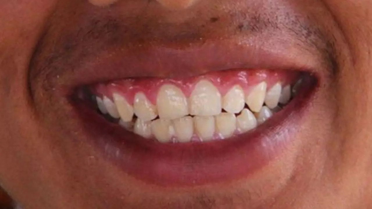 Wearable Tech Goes Dental: Tooth-Mounted Sensor Monitors Saliva for ...