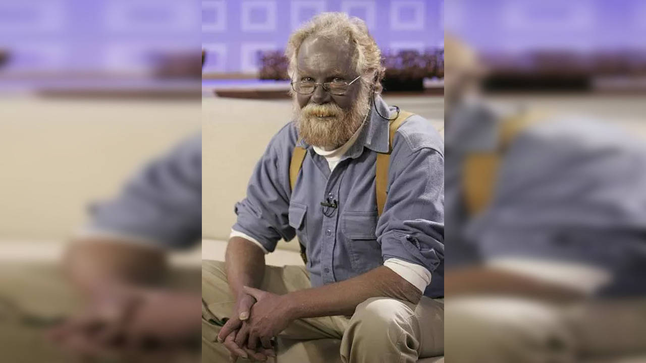 What is argyria, a condition that turns skin colour to blue?