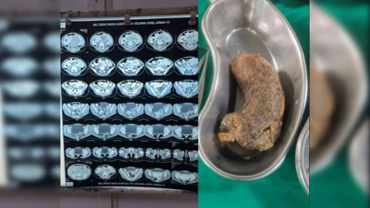 In an unusual surgery, doctors removed a 100 gm hairball from the stomach of a 10-year-old girl from Dadar, who was habituated to plucking her hair and swallowing it.