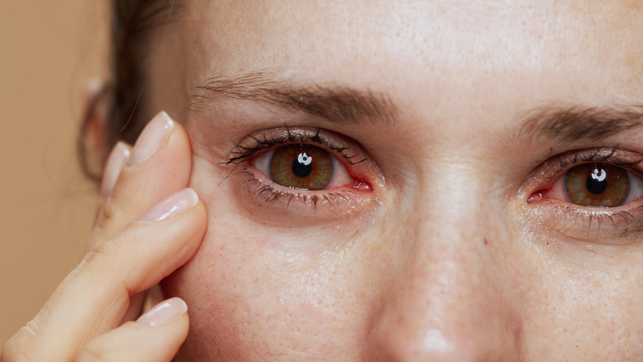 7 Symptoms Of Eye Inflammation Know The Cause And Treatment Health