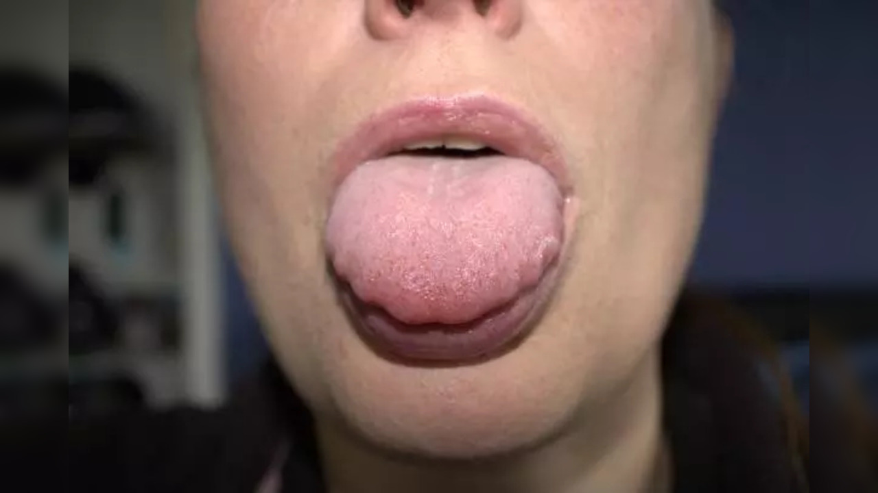 tongue swelling