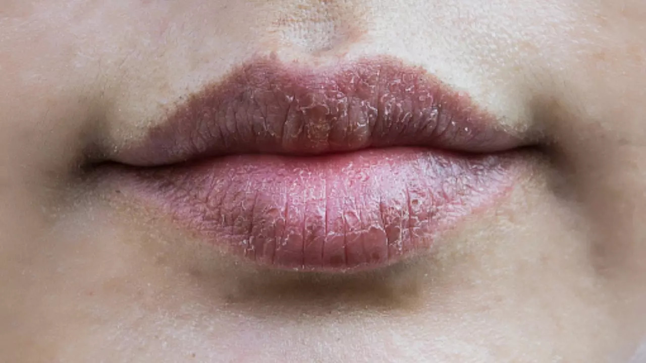 Dry Lips