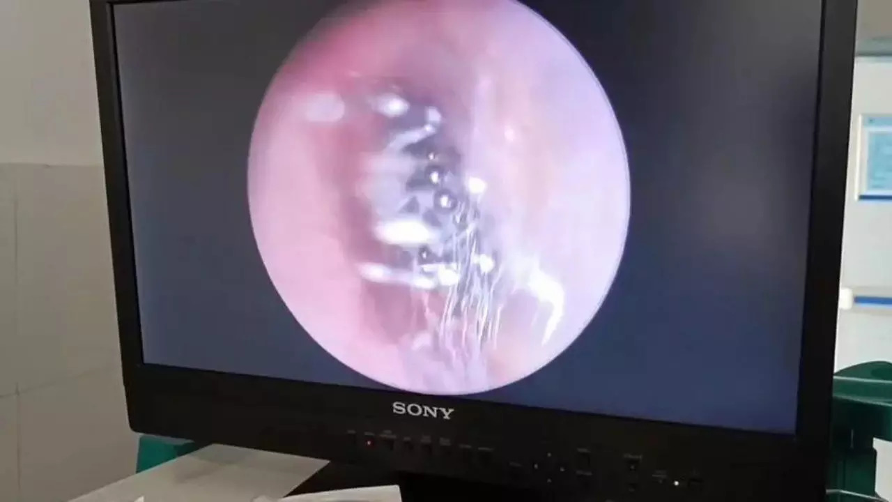 An endoscope inserted into the patient's ear revealed a spider weaving a web inside | Image credit: AsiaWire/Australscope